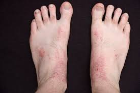 โรคหน้าฝนโรคผิวหนังอักเสบ มือเท้าเปื่อย